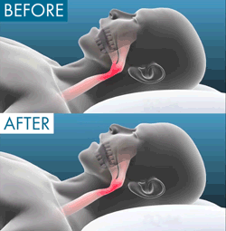 Quiet Night anti-snoring mouthpiece animation